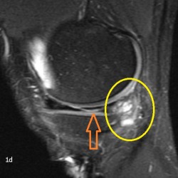 Lesiones Meniscales En MRI - Diagnostico911.org