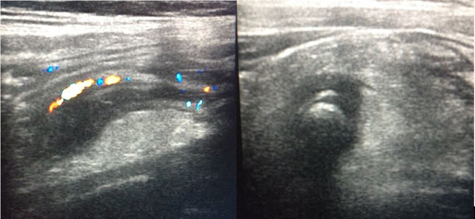 Apendicitis Por UltrasonografÍa 1371