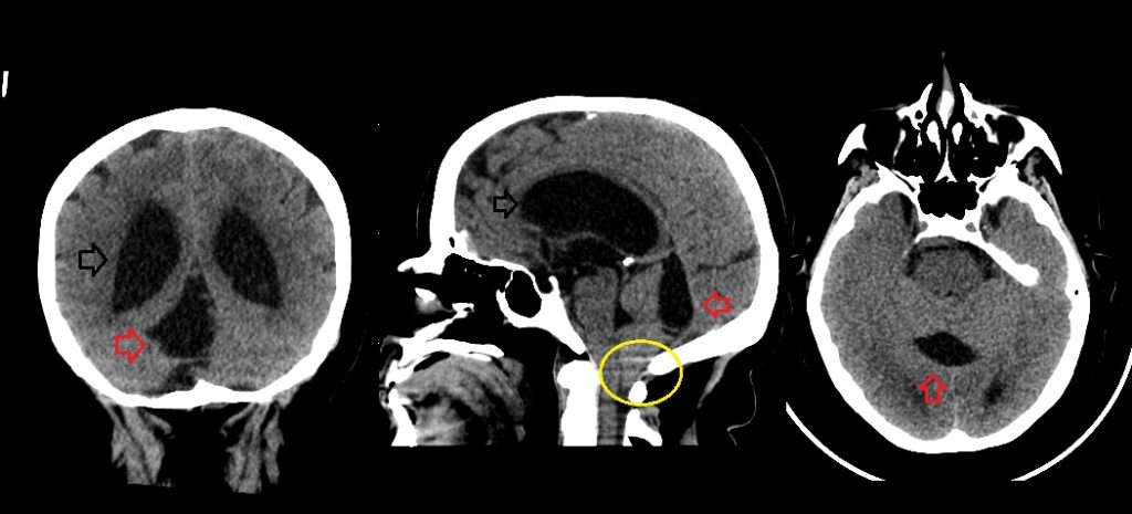 QUISTE ARACNOIDEO - Diagnostico911.org