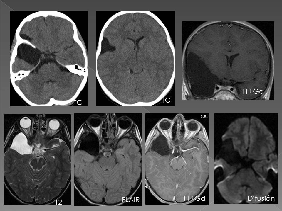 QUISTE ARACNOIDEO - Diagnostico911.org