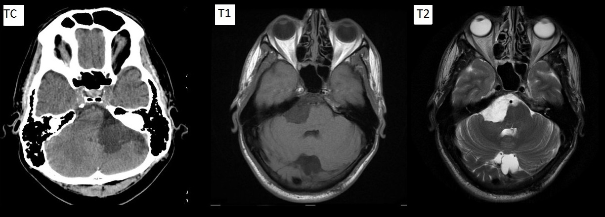 QUISTE ARACNOIDEO - Diagnostico911.org