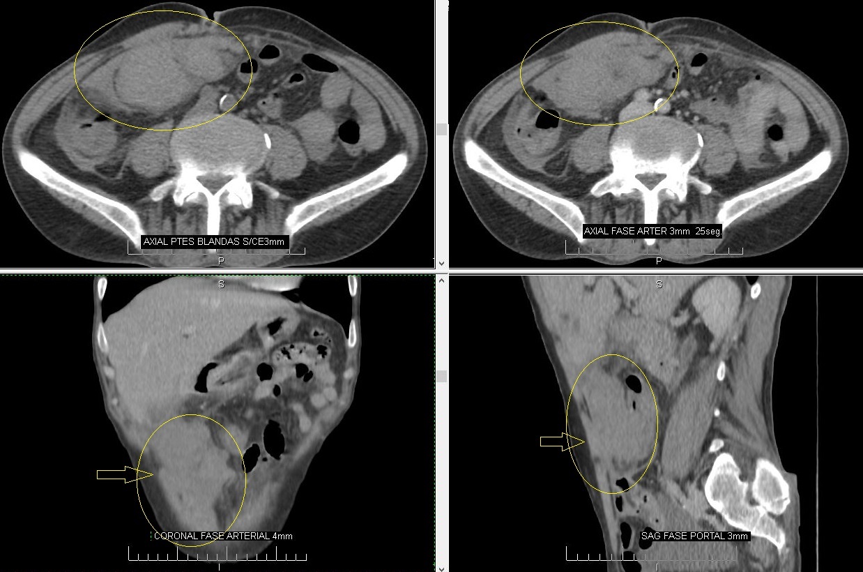 Hematoma Recto anterior del Abdomen - Diagnostico911.org