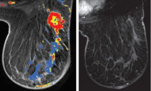 Cáncer Inflamatorio De Mama (CI) - Diagnostico911.org