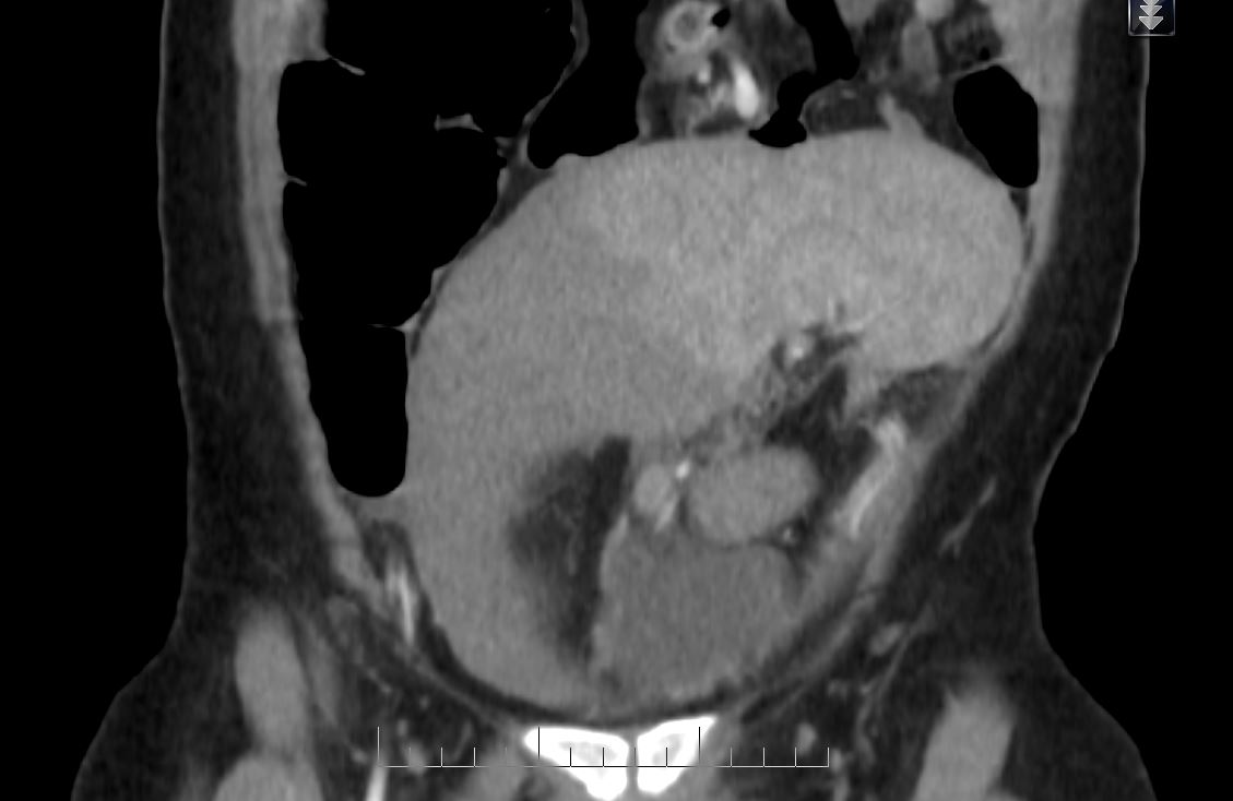 Bazo Ectópico Torsionado - Diagnostico911.org